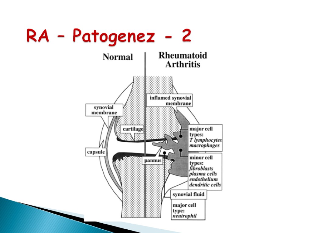 >RA – Patogenez - 2